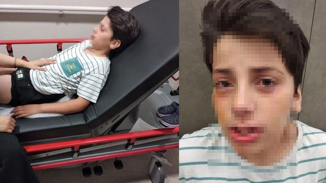 Ses bombası yapımı videosu izleyip, evde denedi; 2 gözünden yaralandı