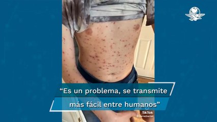 Viruela del mono "no tarda en ser declarada pandemia”: experto de la OMS