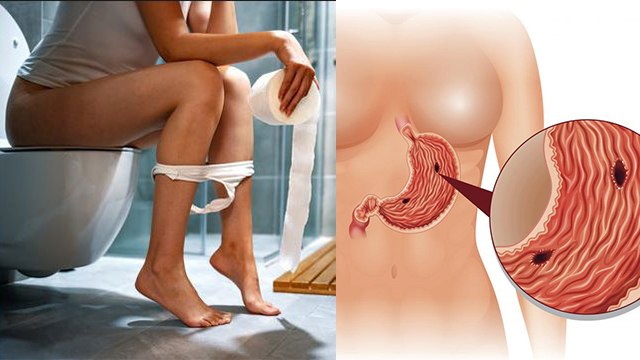 बार बार शौच जाने का कारण क्या है, Irritable Bowel Syndrome Symptoms है वजह | Boldsky *Health
