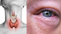 आंख में दर्द Hypothyroidism Symptoms, Reason क्या है। Boldsky*Health