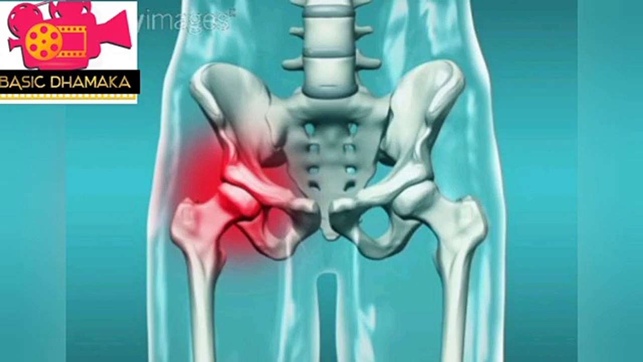 হিপ জয়েন্টের সমস্যা _ Problem in HIP Joint AVN কেন কি কারণে হিপ জয়েন্টের সমস্যা হয় জানুন বিস্তারিত - YouTube
