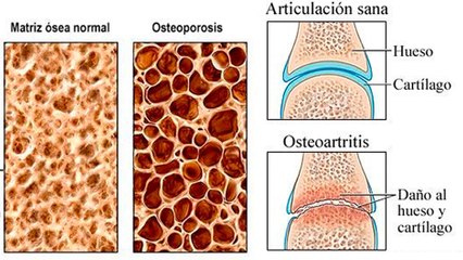 bd-diferencias-osteoporosis-y-osteoartritis-200722