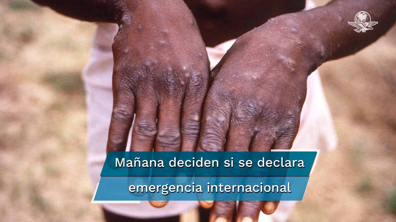 Casos de viruela del mono aumentan a 14 mil en el mundo, alerta OMS