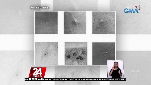 31-anyos na Pilipino galing abroad, kauna-unahang kaso ng Monkeypox sa Pilipinas | 24 Oras