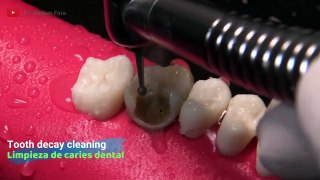 AMAZING Dentist Rebuilds Tooth Damaged By Cavity