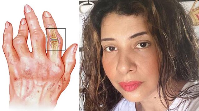 Sambhavna Seth को Arthritis लाइलाज बीमारी,Symptoms Reasons चौंकाने वाले । Boldsky *Health