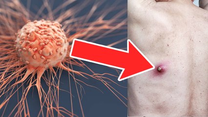 Body के इन Parts में Sarcoma Tumor Symptoms, गलती से भी  नजरंदाज न करें |Boldsky*Health