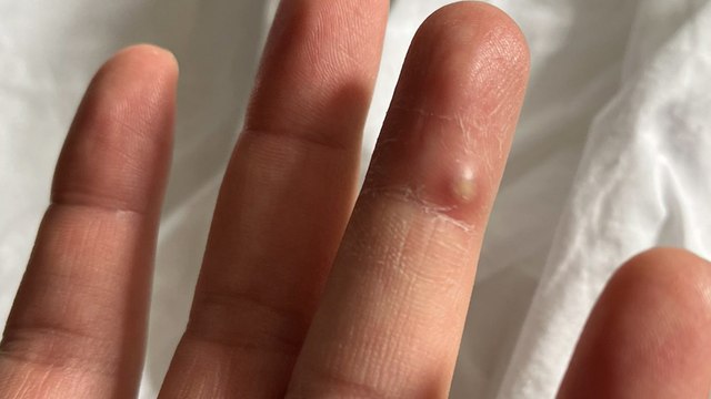 Variole du singe : « Je ne souhaite à personne de vivre ce que j'ai traversé »