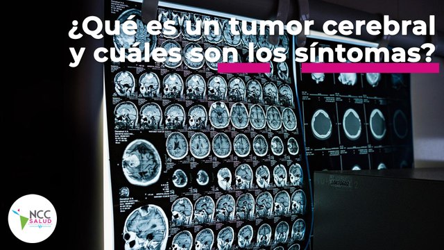 ¿Qué es un tumor cerebral y cuáles son los síntomas? | 103 | 25 al 31 de julio 2022