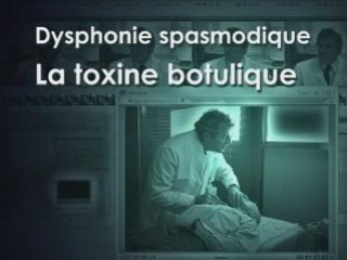 Dysphonie spasmodique, la toxine botulique