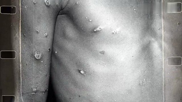 DSÖ acil durum ilan etti! Maymun çiçeği virüsü ortalığı karıştırdı: Ölümler git gide artıyor