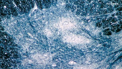 ارتفاع حالات شلل الأطفال في باكستان هذا العام إلى 13