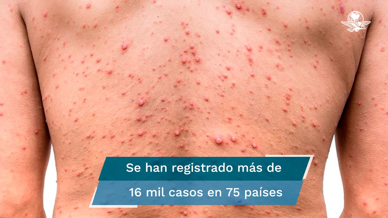 Viruela de mono: ¿cuáles son los síntomas?, ¿cómo se transmite?