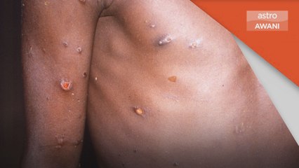 Cacar Monyet | Kes pertama dikesan pada kanak-kanak di A.S