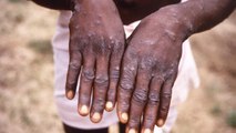 Delhi Man with no history of foreign travel tests positive for monkeypox