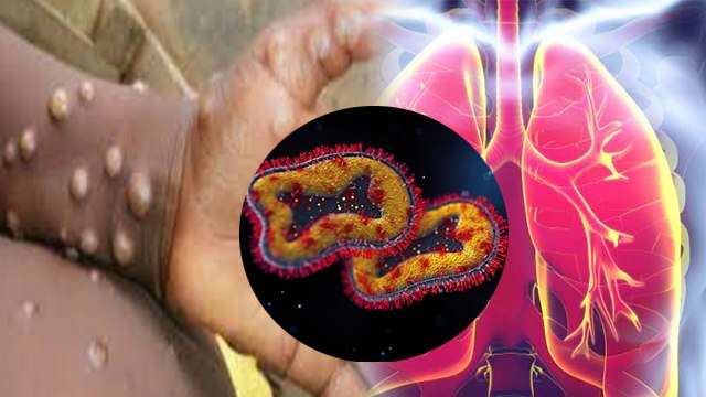 Monkey Pox से किन लोगो को ज्यादा खतरा | मंकी पॉक्स से बचाव | Boldsky *Health