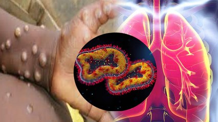 Monkey Pox से किन लोगो को  ज्यादा खतरा | मंकी पॉक्स से बचाव | Boldsky *Health