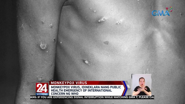Monkeypox virus, idineklara nang public health emergency of international concern ng WHO | 24 Oras Weekend