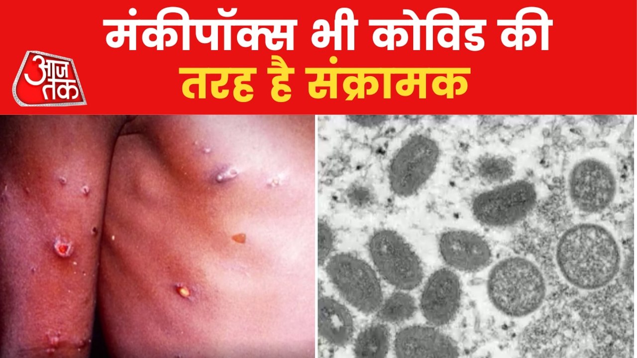 Monkey Pox is also contagious like Corona Virus!