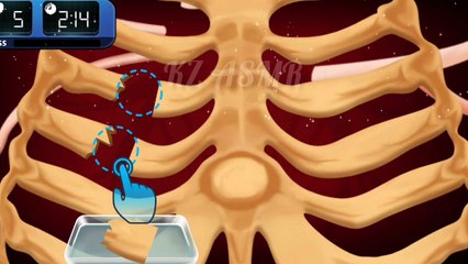 Ribs Fracture Fixture Treatment Animation - ASMR Video 2022 | KZ ASMR