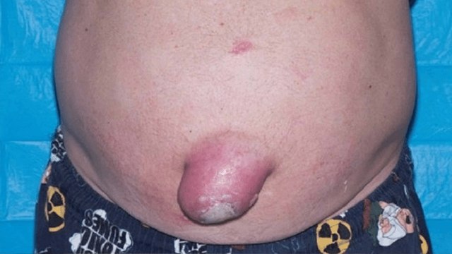 नाभी में सूजन क्यों होती है | Nabhi me sujan ka karan | Boldsky | *Health