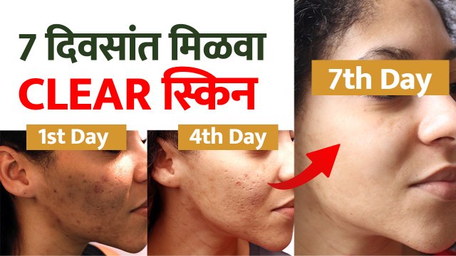 क्लिअर स्किनसाठी करा हे घरगुती उपाय | 7 Days Clear Skin Challenge | How To Get Clear Skin Naturally