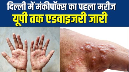 Monkeypox Virus: दिल्ली से यूपी तक मंकीपॉक्स का कहर, लोग करवा रहे है हॉस्पिटल मैं बेड रिज़र्व