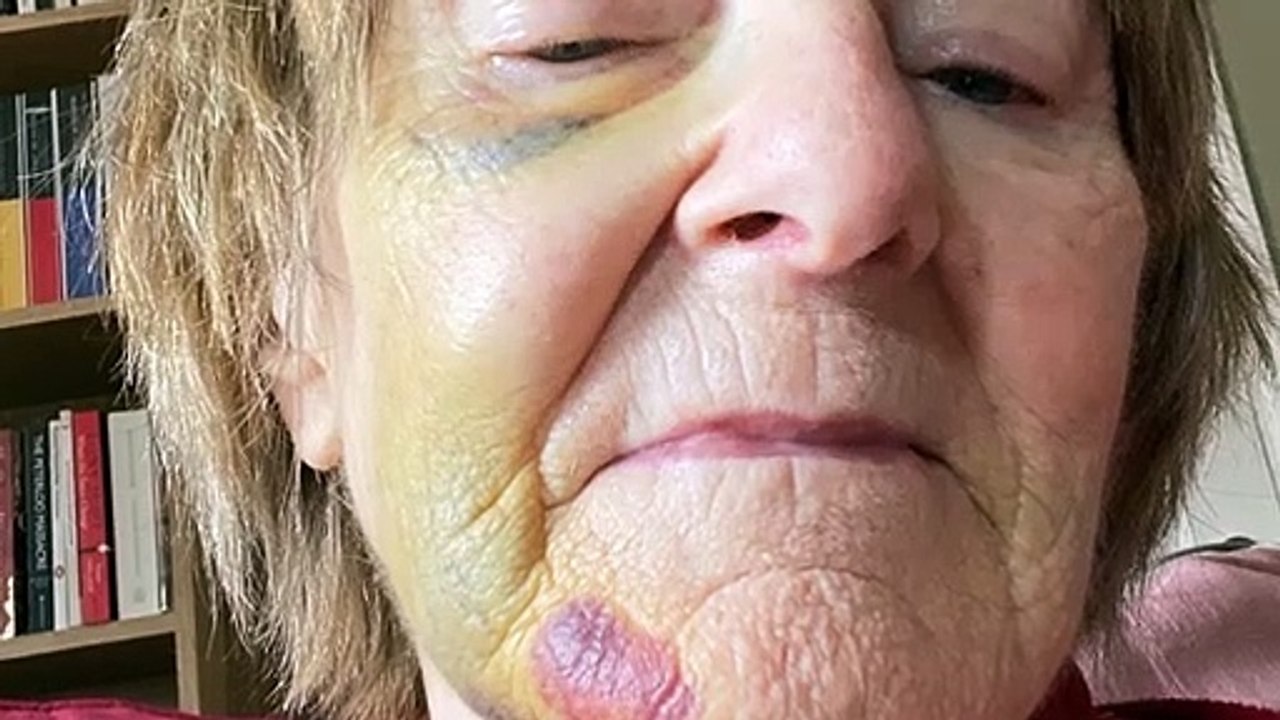 E scooter crash victim from Canterbury tells of ordeal