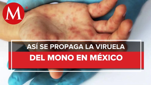 México acumula 60 casos de viruela del mono; no hay reporte de muertos: Conave