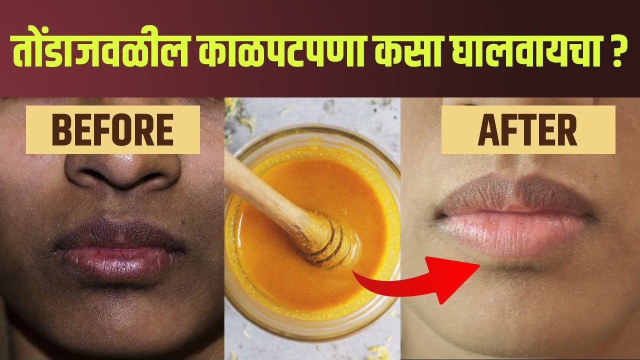 तोंडाजवळचा काळपटपणा घालवण्यासाठी रामबाण उपाय | How To Get Rid Of Pigmentation On Mouth
