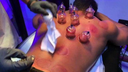 Xpert Maskulin : Kesan Selepas Berbekam Patut Anda Tahu