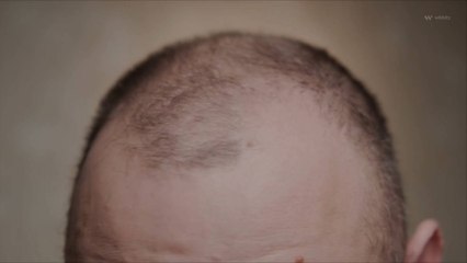 Une nouvelle étude identifie la source de la perte de cheveux