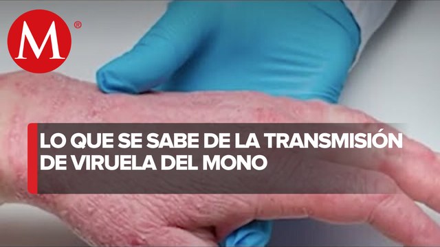 Puebla reporta primeros dos casos de viruela del mono; contagio fue importado