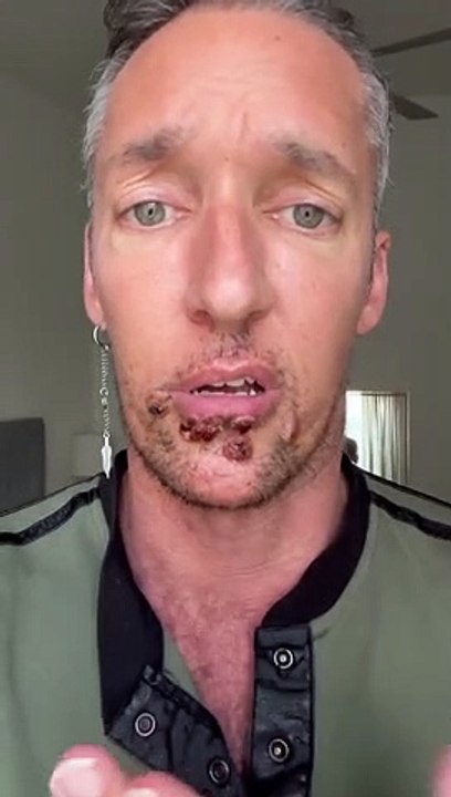 Variole du singe : Pour la première fois, un acteur porno, accepte de témoigner et de montrer les ravages du virus sur son visage (Attention la vidéo peut- être choquante)