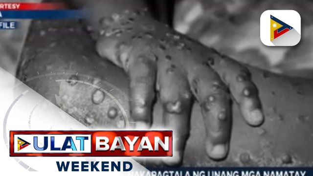 Kauna-unahang kaso ng nasawi sa monkeypox sa labas ng Africa, naitala sa Spain at Brazil