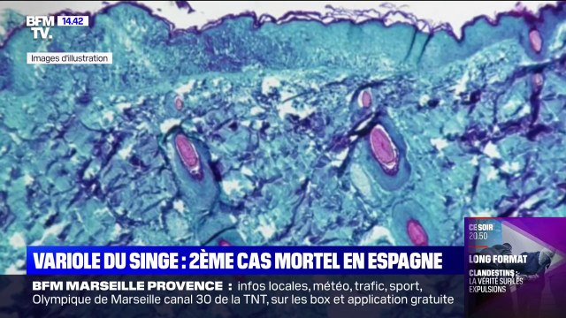 Variole du singe: un deuxième cas mortel en Espagne