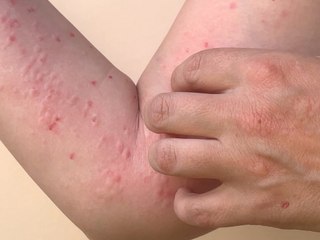 Erster Affenpocken-Todesfall in Europa gemeldet