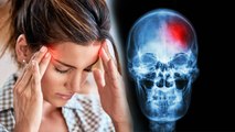 Cluster Headache क्या होता है | Cluster Headache Symptoms को न करें नजरंदाज |Boldsky*Health