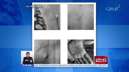 Monkeypox, wala pang lunas o gamot; Pag-develop ng antiviral agents para rito, patuloy | UB