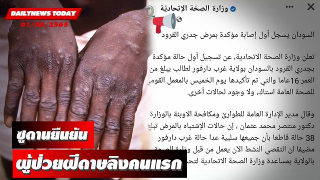ซูดานยืนยันผู้ป่วยฝีดาษลิงคนแรก แอฟริกาจี้ขอวัคซีน | DAILYNEWS TODAY 01/08/65