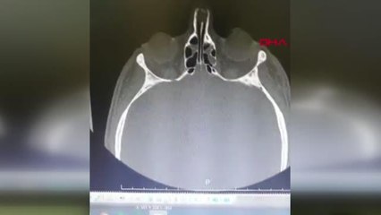 HASTA YAKINI, HEMŞİRENİN KAFATASI VE BURNUNU KIRDI