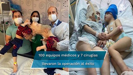 Siameses unidos por la cabeza, son separados con éxito