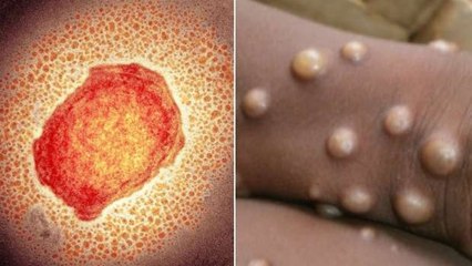 నో ట్రావెల్ హిస్టరీ... అయినా పెరుగుతున్న మంకీపాక్స్ కేసుల సంఖ్య *National | Telugu OneIndia