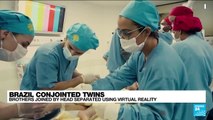Brazil: Conjoined twins separated with help of virtual reality