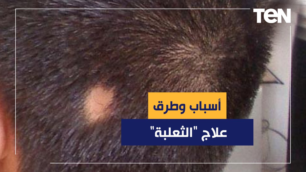 دكتور هاني الناظر يكشف أسباب وطرق علاج "الثعلبة"