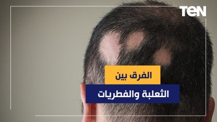 كيف تفرق بين الثعلبة والفطريات مع الدكتور هاني الناظر