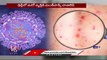 Monkeypox Updates _Third monkeypox case Detected In Delhi  | V6 News (2)