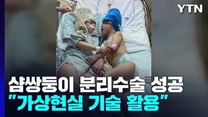 브라질 샴쌍둥이 분리수술 성공..."가상현실 활용" / YTN