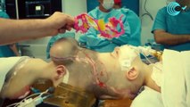 Una cirugía hecha en una sala de operaciones virtual separa a una pareja de gemelos unidos por la cabeza