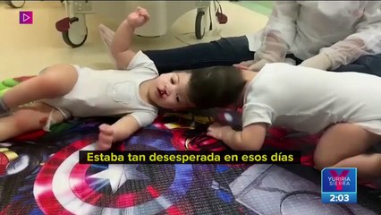 Hazaña médica les dio una nueva oportunidad de vida a siameses